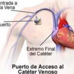 colocacion-cateter-de-puerto-cirujano-oncologo-cancun.jpg